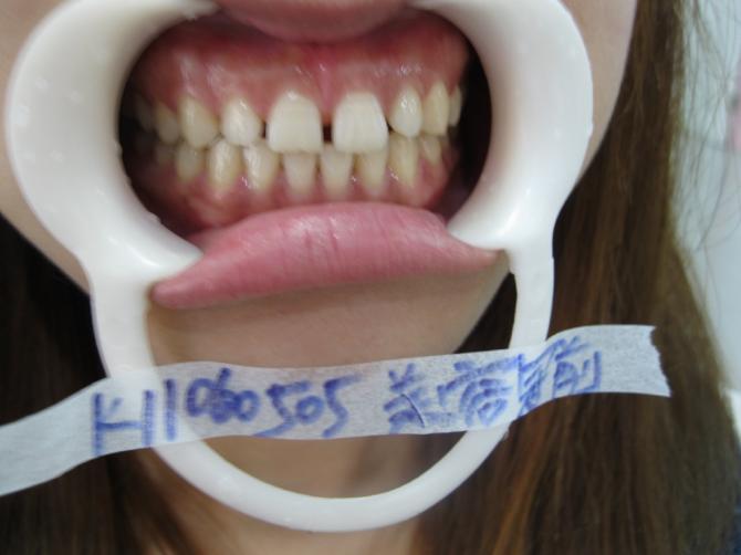 33岁牙齿为什么突然缝隙大 成人牙缝隙大怎么修复