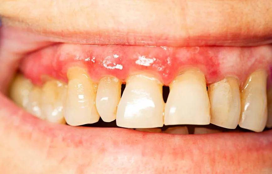 牙齿二边缝隙大怎么办，产后牙齿缝隙变大这几个小秘诀帮你预防
