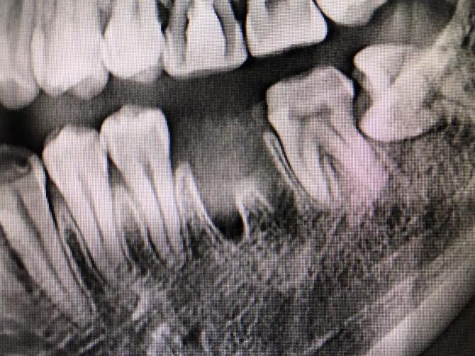 牙齿缺失的原因及调理方法，牙齿缺失的影响